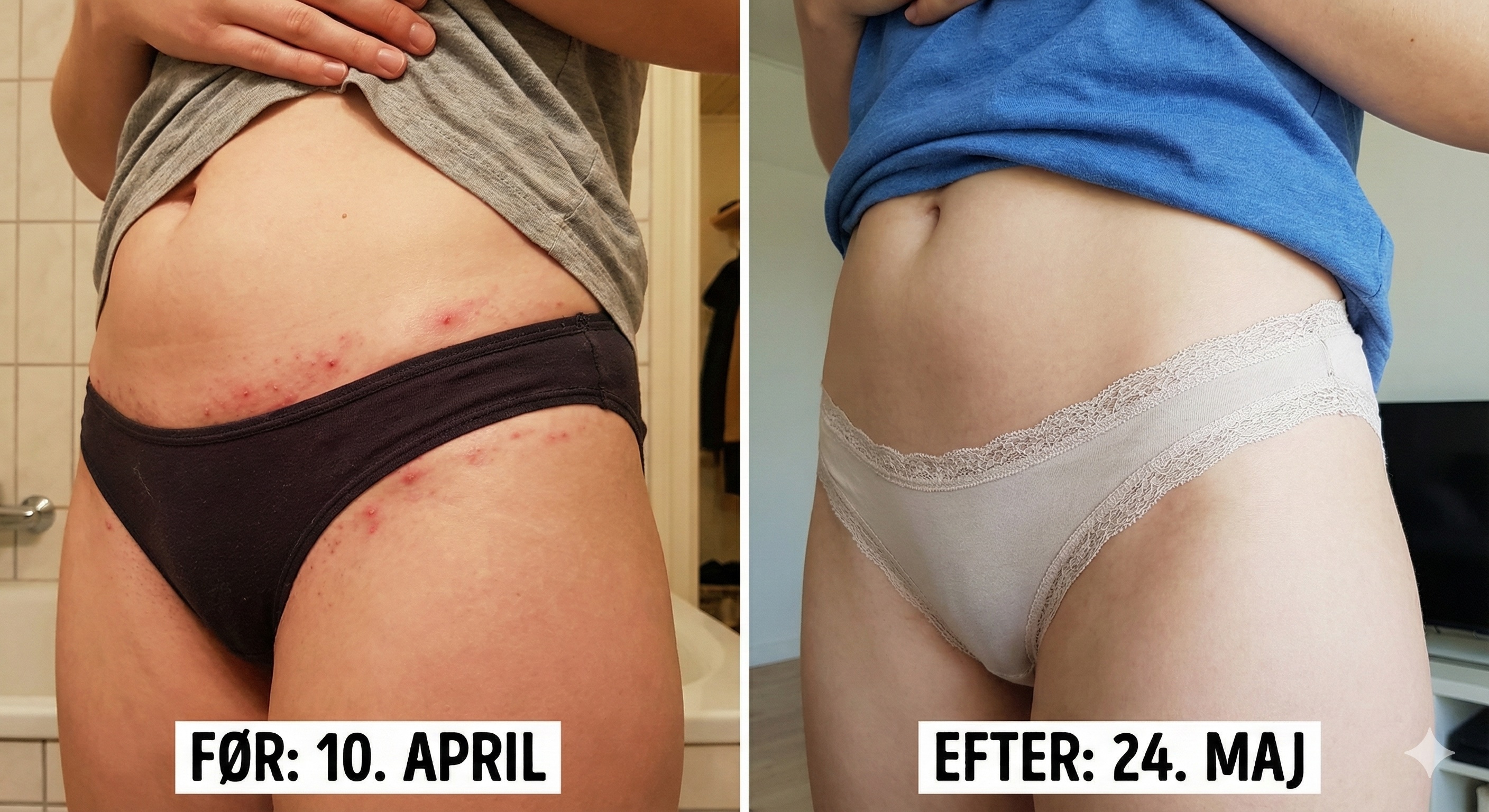 F&oslash;r og efter &mdash; bikinilinje
